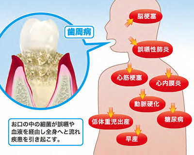 お口の中の細菌が誤嚥や血液を経由し、全身へと流れ疾患を引き起こすことがあります。